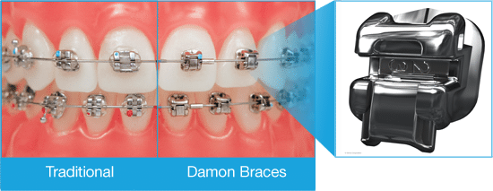 Q&M Braces, Types of Braces, Straighten teeth, Invisible braces, Speech  improvement